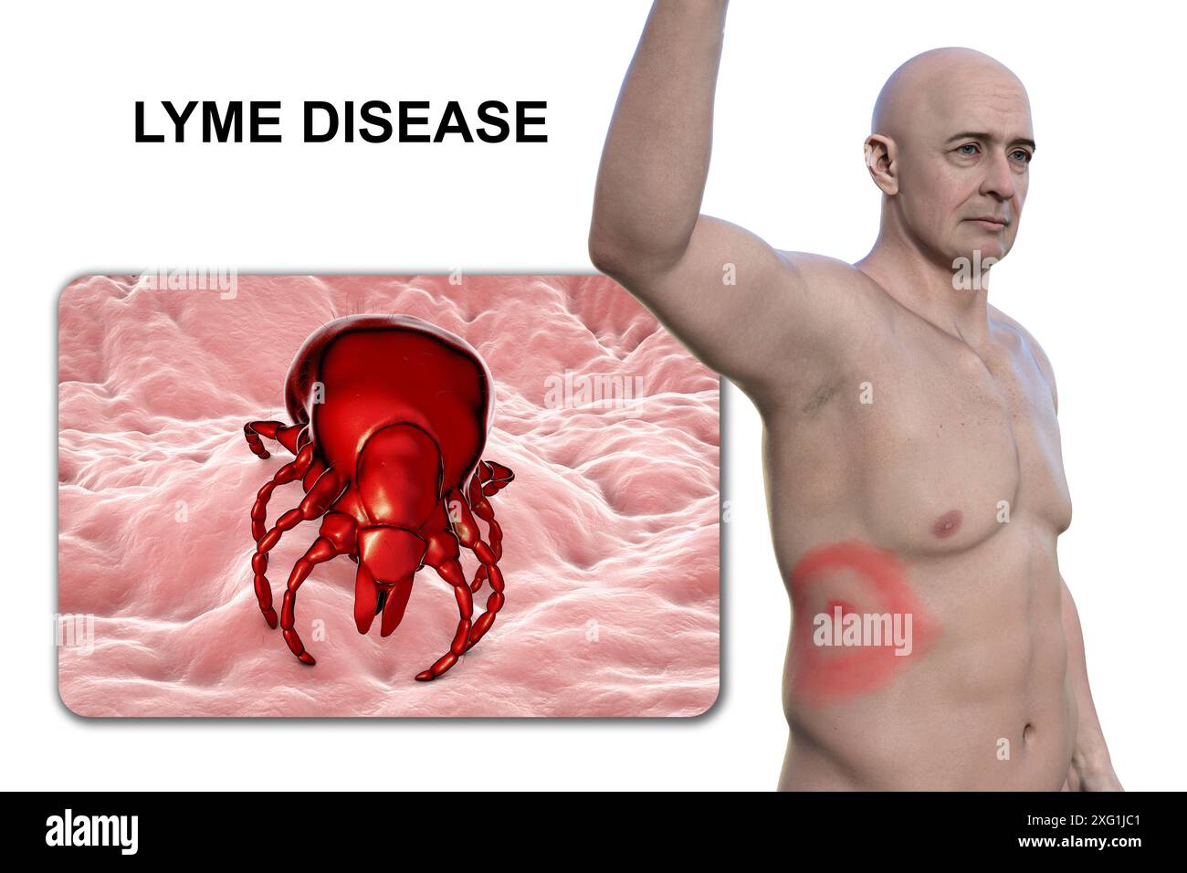 Illustration showing erythema migrans, a characteristic rash seen in ...