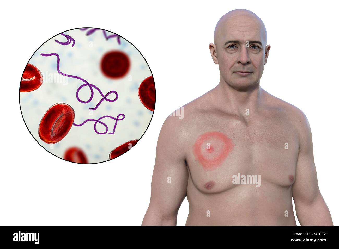 Illustration showing erythema migrans, a characteristic rash seen in ...
