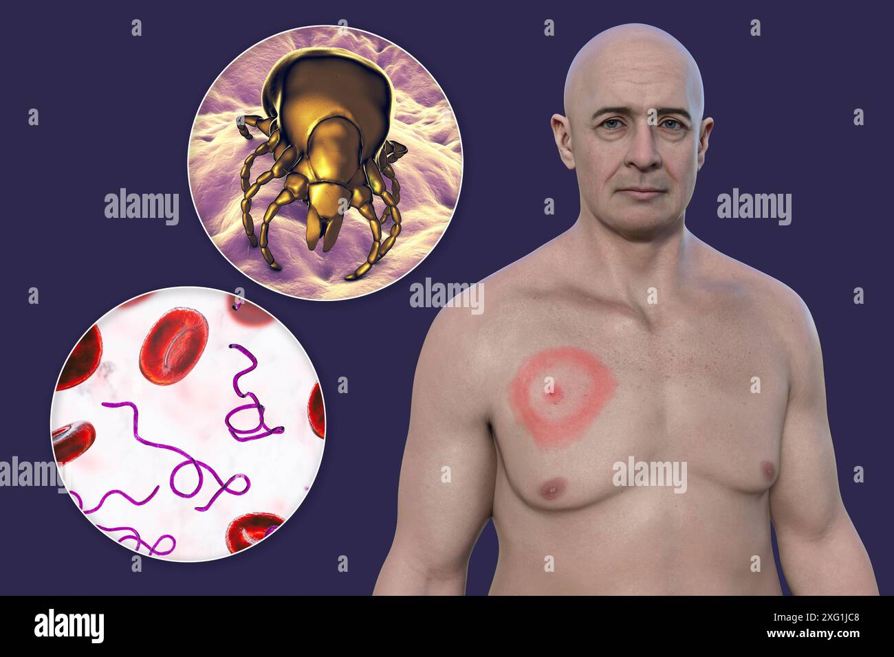 Illustration showing erythema migrans, a characteristic rash seen in ...