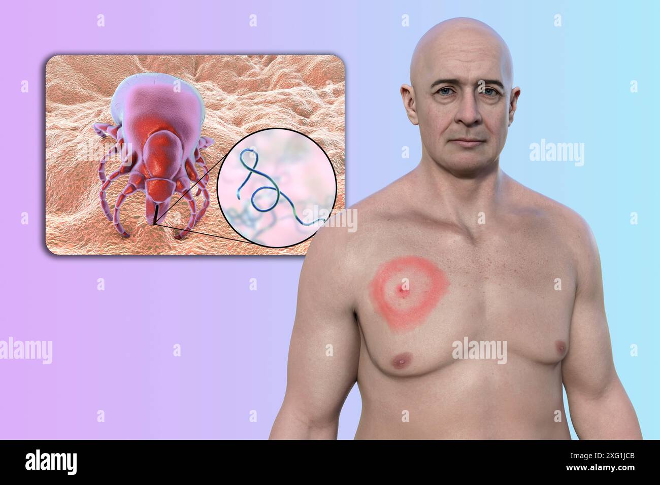 Illustration showing erythema migrans, a characteristic rash seen in ...