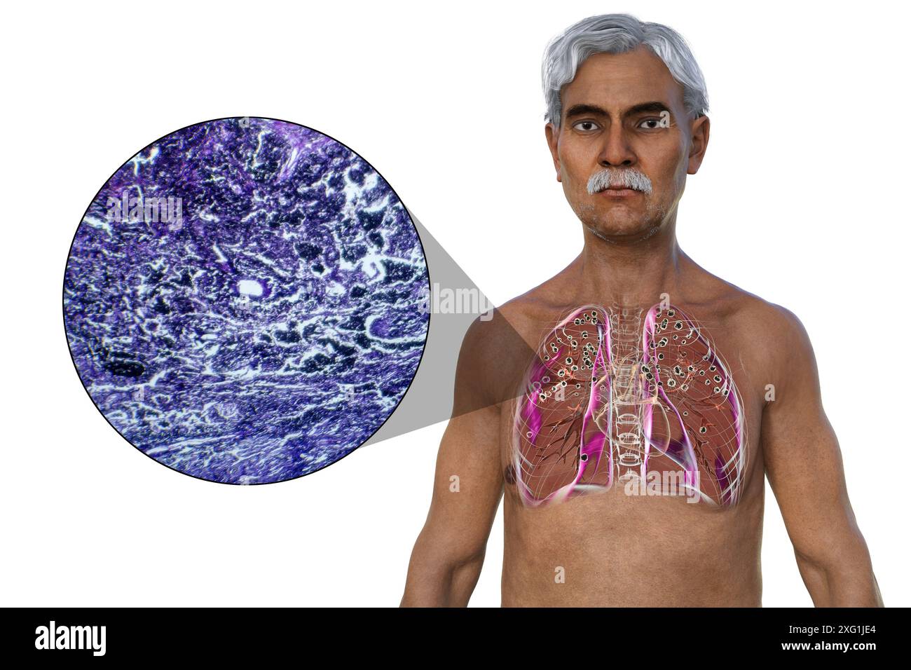 Illustration of a man with lungs affected by silicosis, showing dark ...