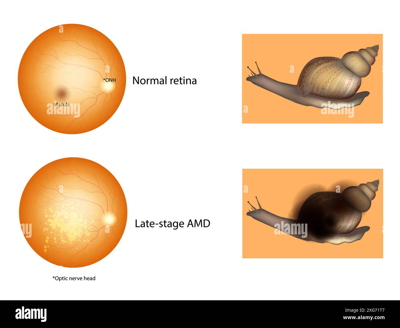Normal Rertina Age-Related Macular Degeneration or AMD. Late-stage AMD and Normal ...