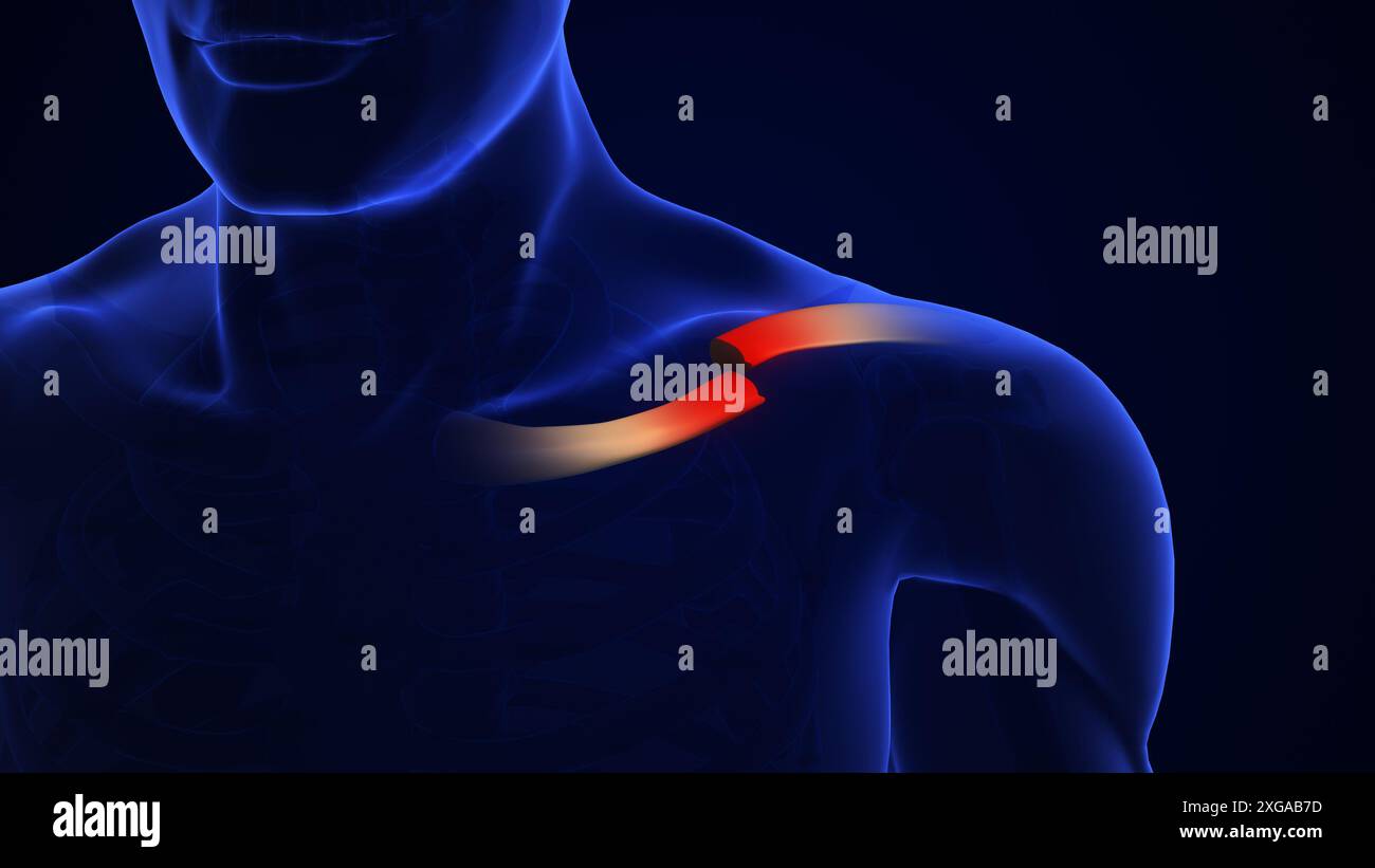 Clavicle Bone Fracture medical concept Stock Photo