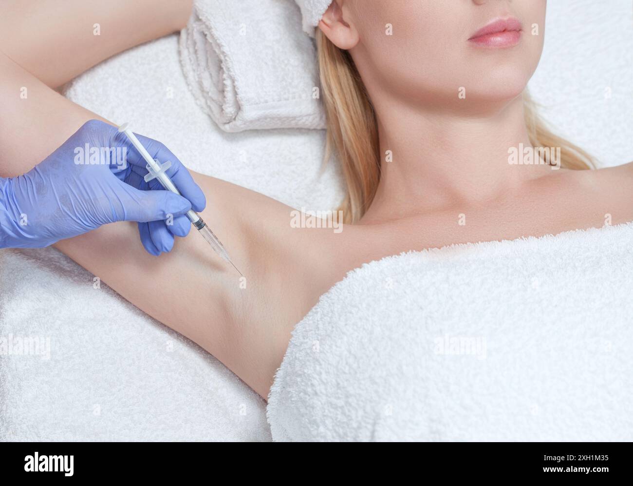 Hyperhydrosis Injection The doctor makes injections of botulinum toxin in the underarm area ...