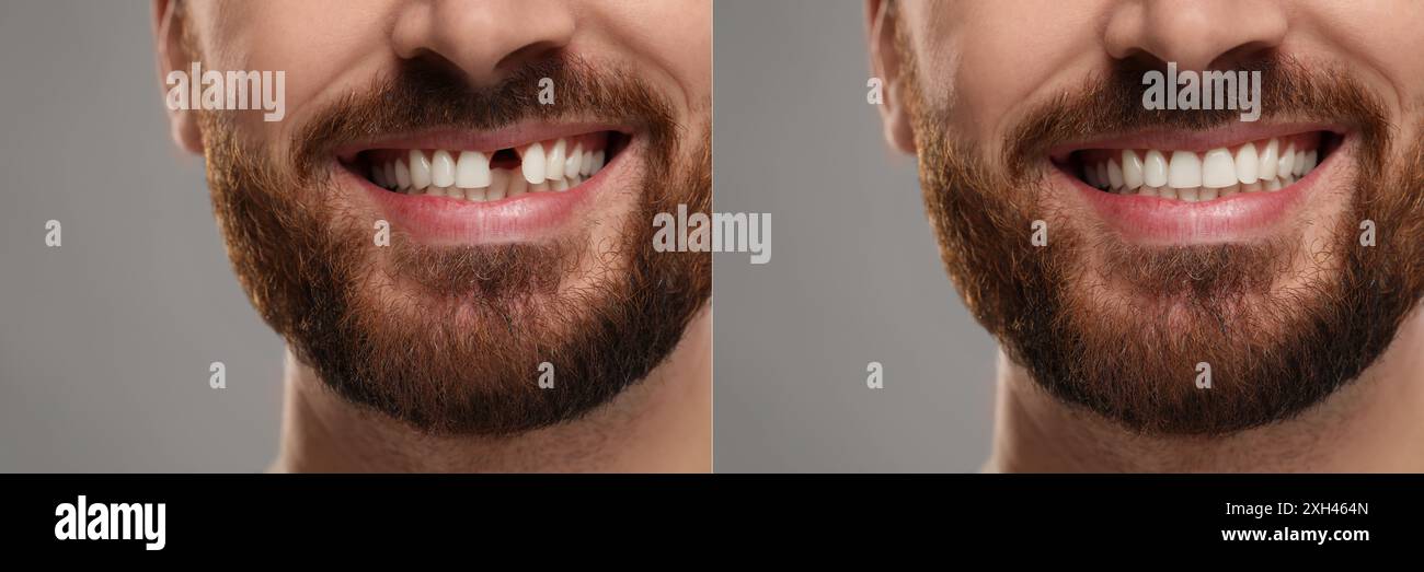 Man showing teeth before and after dental implant surgery, closeup ...