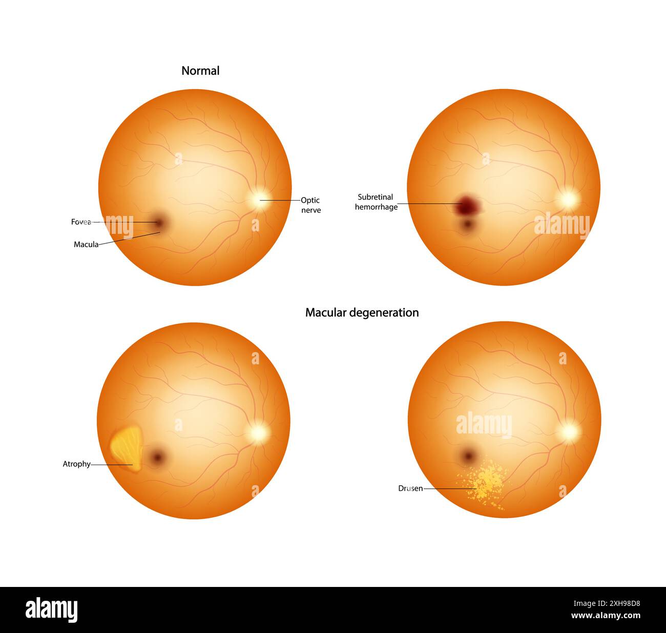 Normal retina and Macular degeneration Drusen, Atrophy, Subretinal hemorrhage. Stock Vector