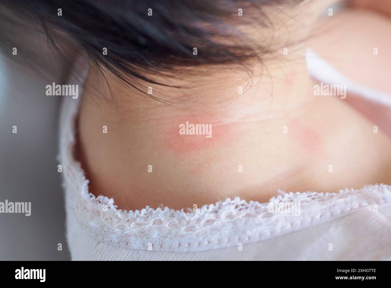 baby skin rash and allergy with red spot cause by mosquito bite at neck Stock Photo