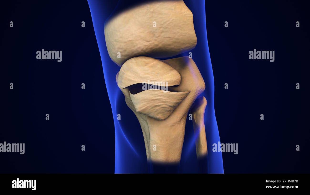 Broken Patella Bone medical concept Stock Photo - Alamy