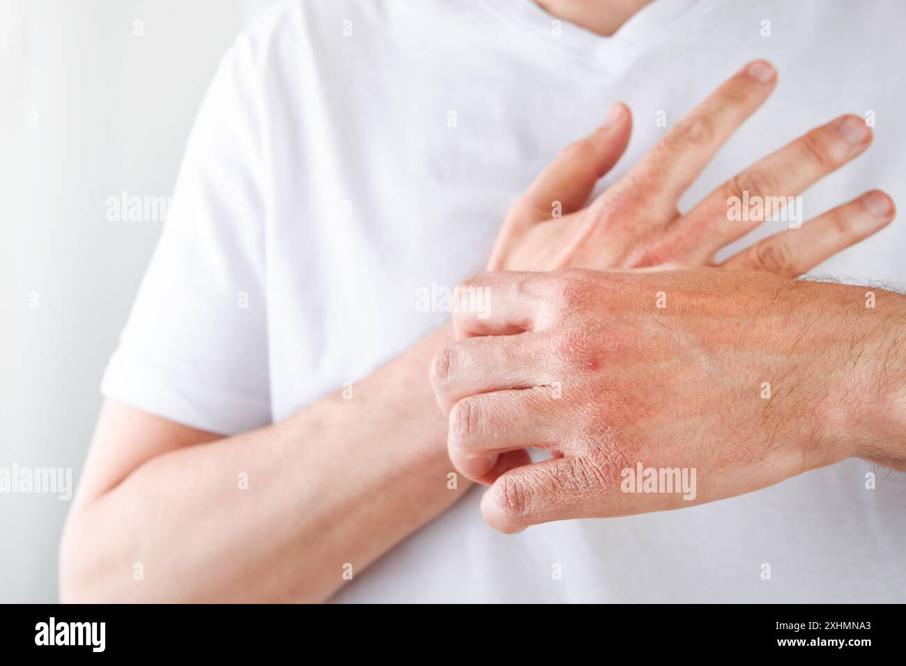 Man scratches or shows hands with dry, cracked skin on white ...