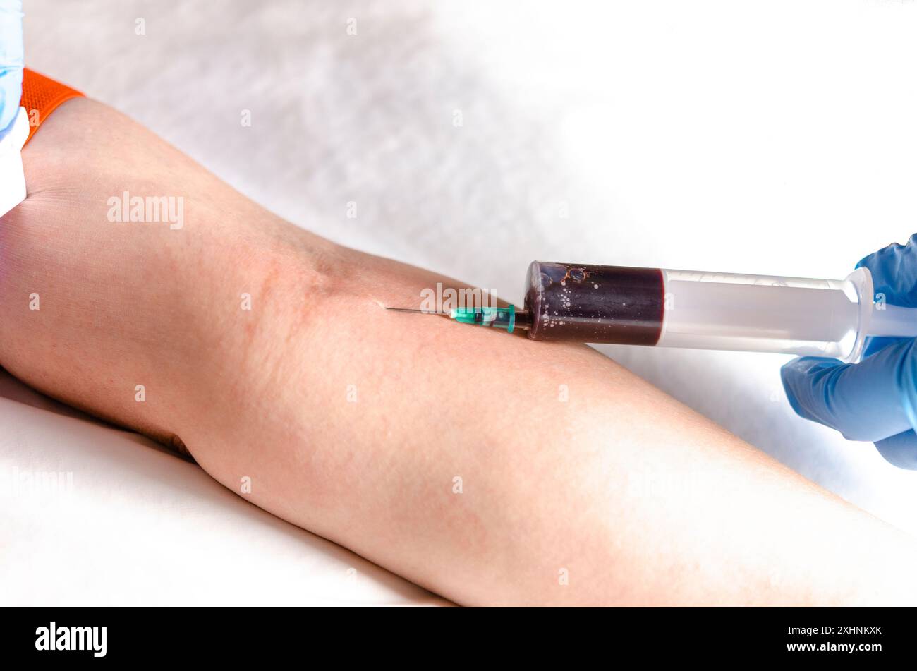 Blood sampling for analysis. Nurse's hands with a gloved syringe. Stock Photo