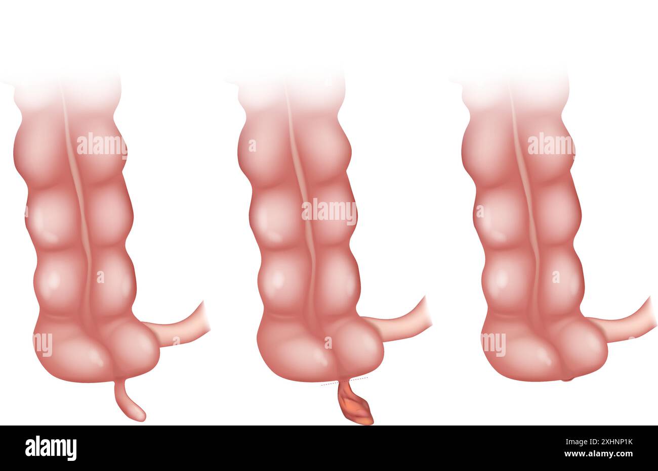 Laparoscopic appendectomy Stock Vector Images - Alamy