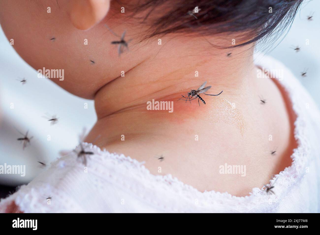 cute asian baby girl has rash and allergy on neck skin from mosquito ...