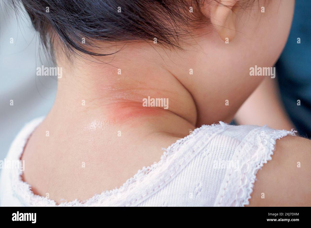 baby skin rash and allergy with red spot cause by mosquito bite at neck Stock Photo