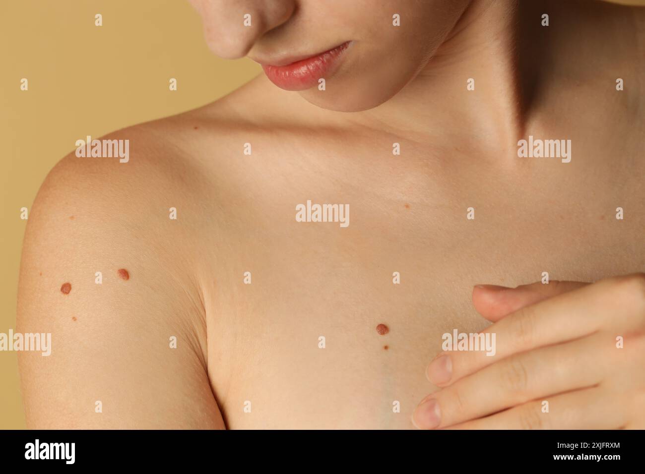 Woman with moles on her skin against beige background, closeup Stock Photo