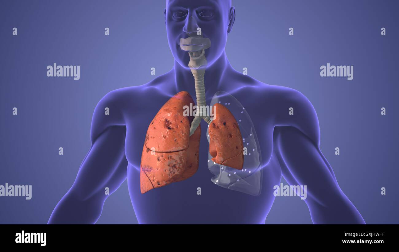 Lungs pneumothorax disease medical concept Stock Photo