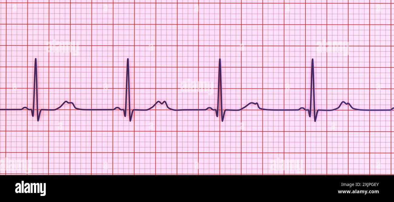 Illustration of an electrocardiogram ecg showing prolonged qt