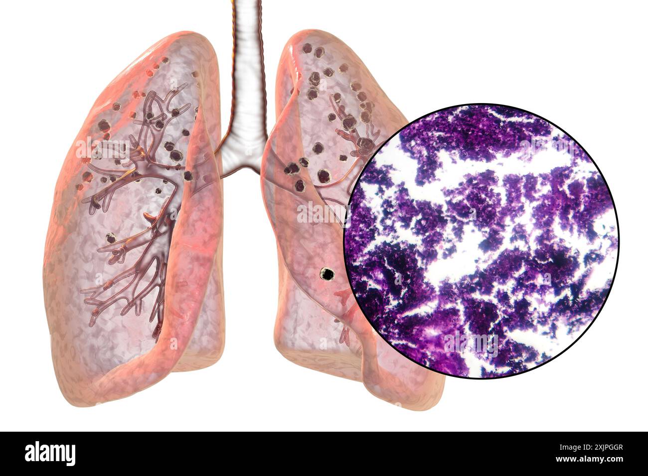 Illustration depicting lungs affected by silicosis, revealing dark ...