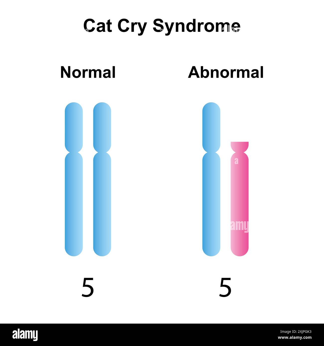 Cat Cry Syndrome Illustration Stock Photo Alamy cri-du-chat-syndrome-cat-s-cry-syndrome-monosomy-5p-ppt-download