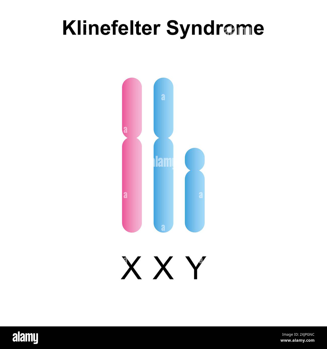 Klinefelter syndrome, illustration. Stock Photo