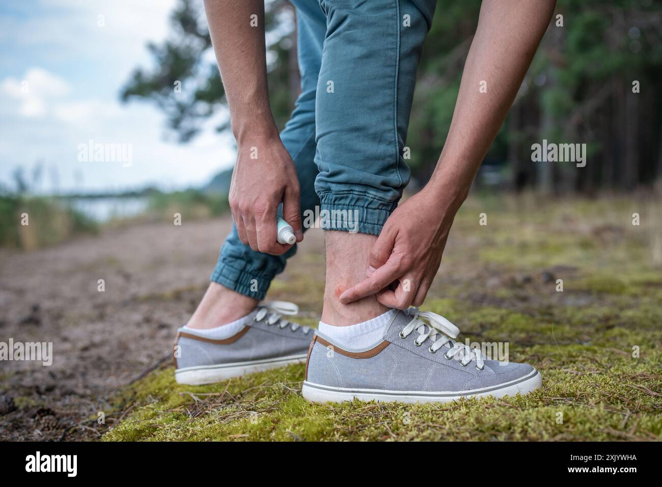 Man with mosquitoes bites itching leg, applying balm on swell skin, suffering from allergic reaction Stock Photo