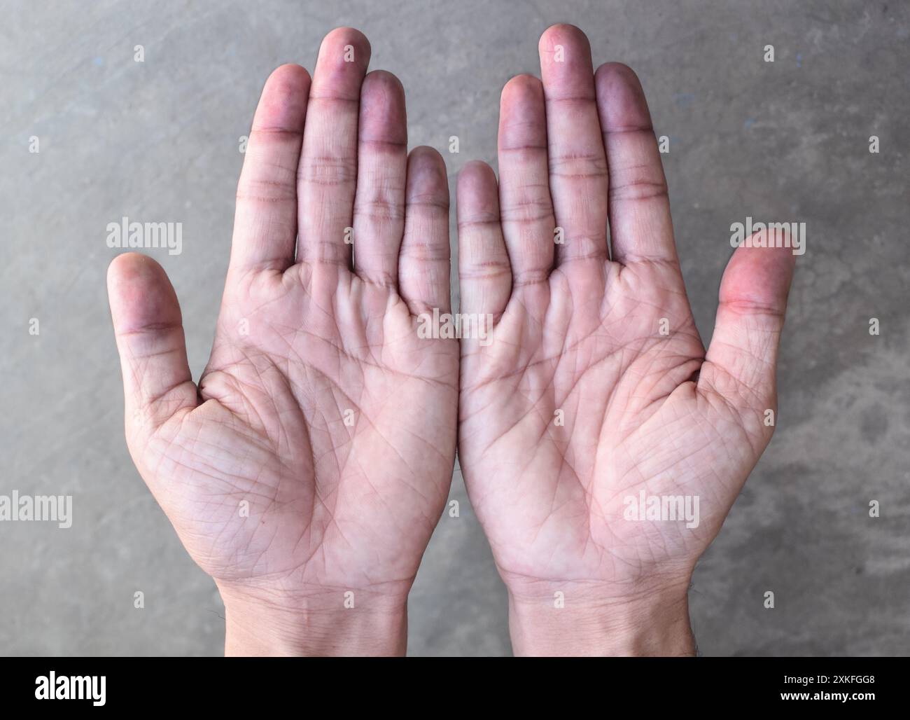 Cyanotic hands or peripheral cyanosis or blue hands at Southeast Asian, Chinese man Stock Photo