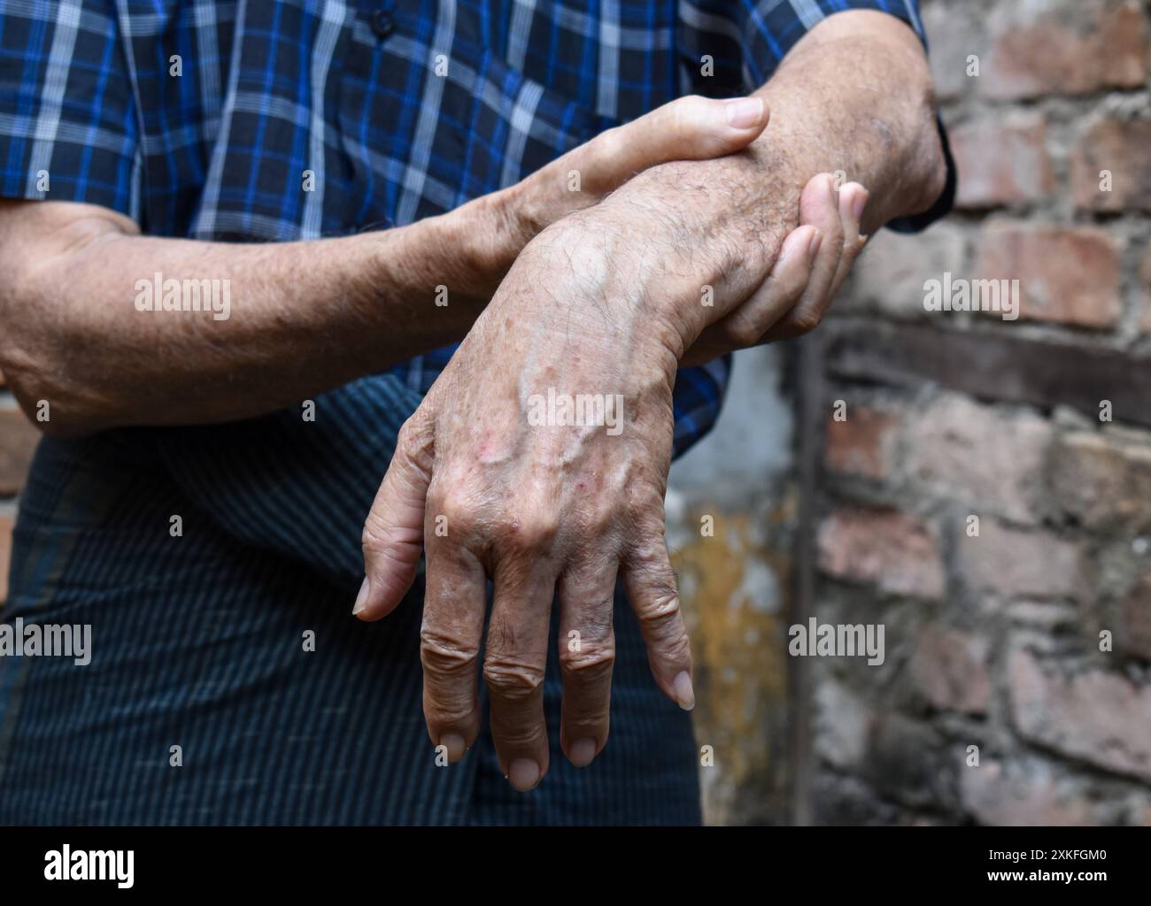 Drop Injury Radial nerve injury or wrist drop of Asian elder man Stock Photo - Alamy