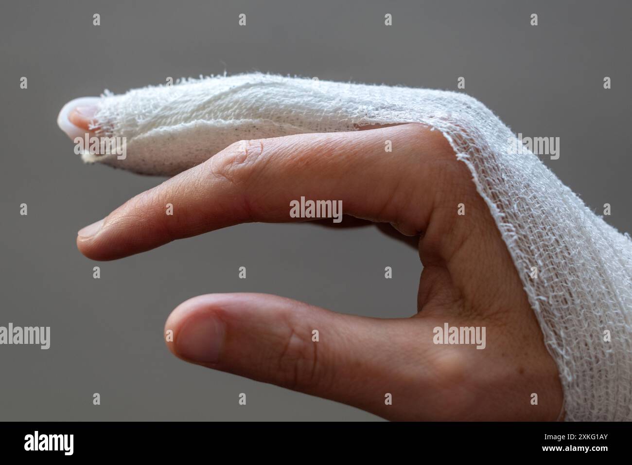 Mallet finger, stack splint on the middle finger with bandage to ...