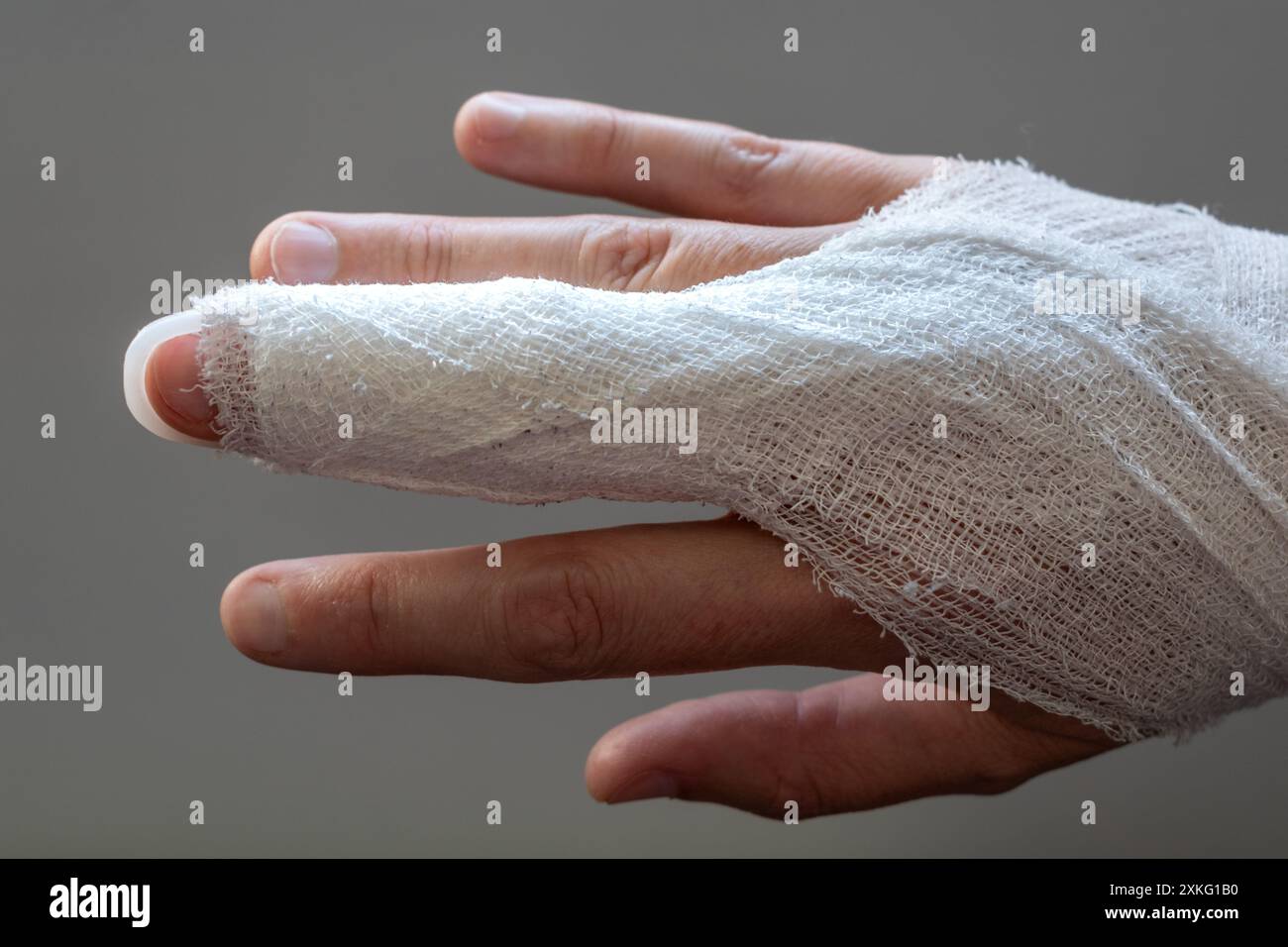 Mallet finger, stack splint on the middle finger with bandage to ...