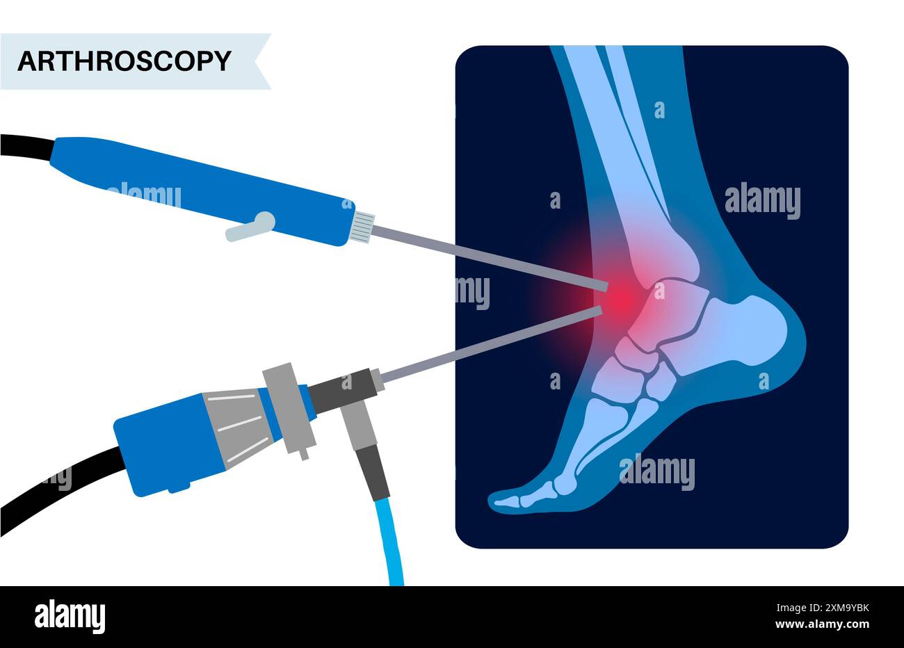 Foot Incision Illustration of an ankle arthroscopy procedure. This is a procedure for ...