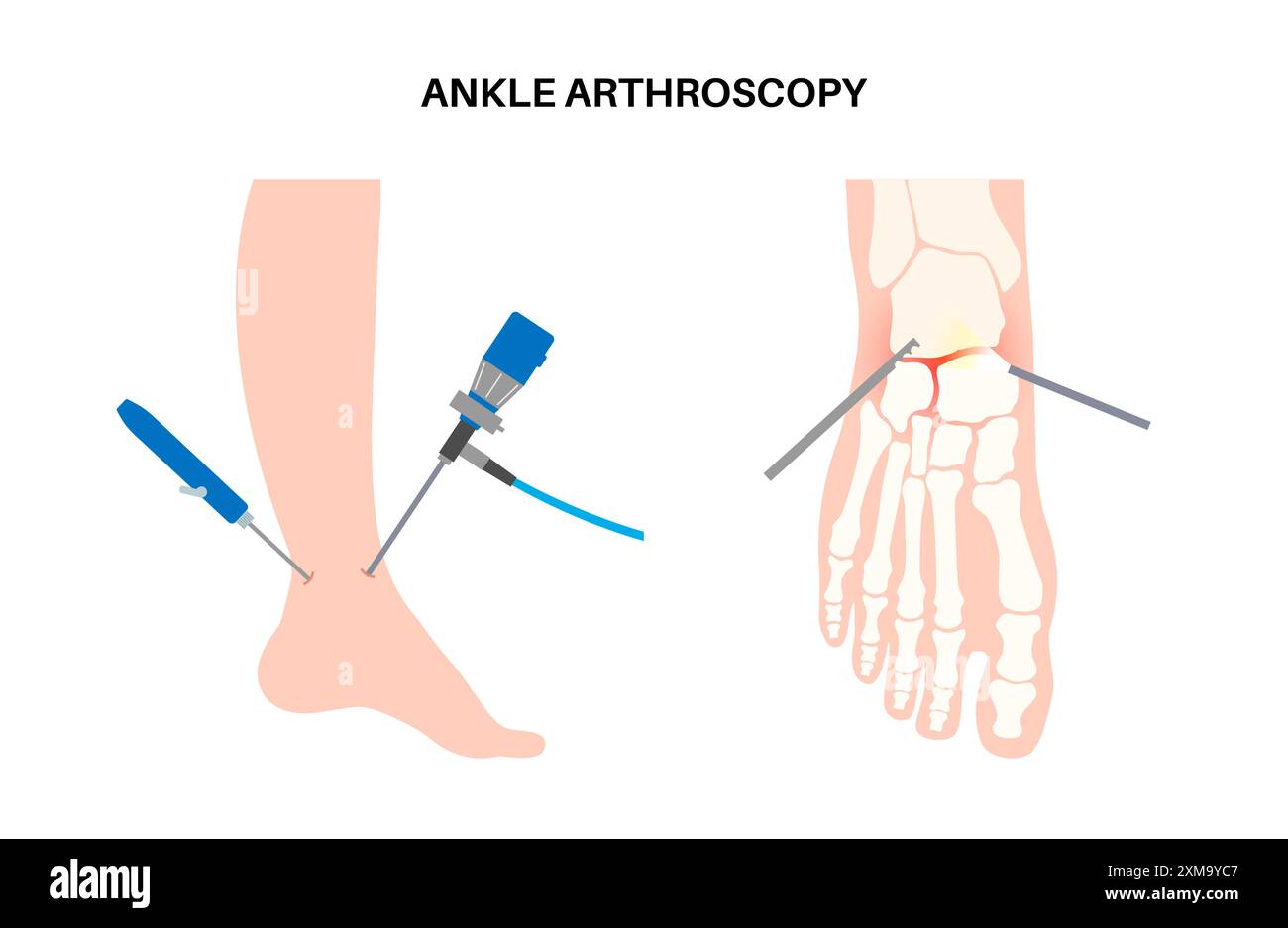 Illustration of an ankle arthroscopy procedure. This is a procedure for ...