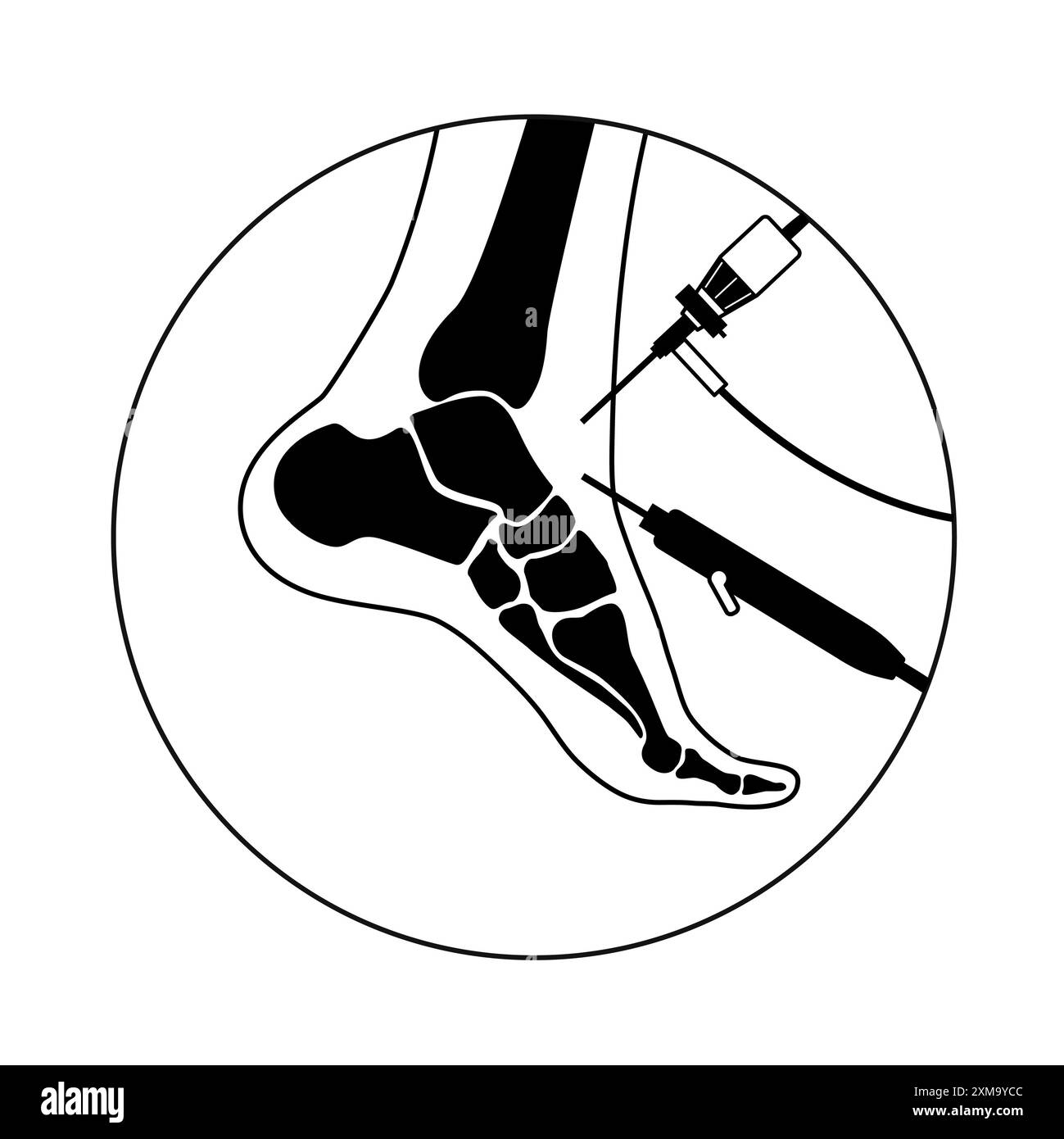 Illustration of an ankle arthroscopy procedure. This is a procedure for ...