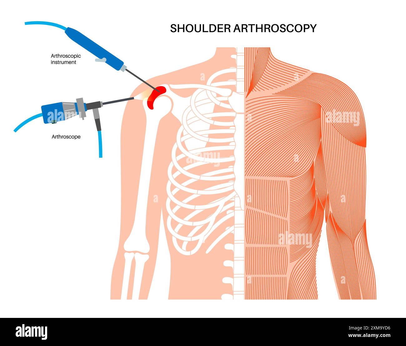 Shoulder Incision Names Shoulder arthroscopy procedure hi-res stock photography and images - Alamy