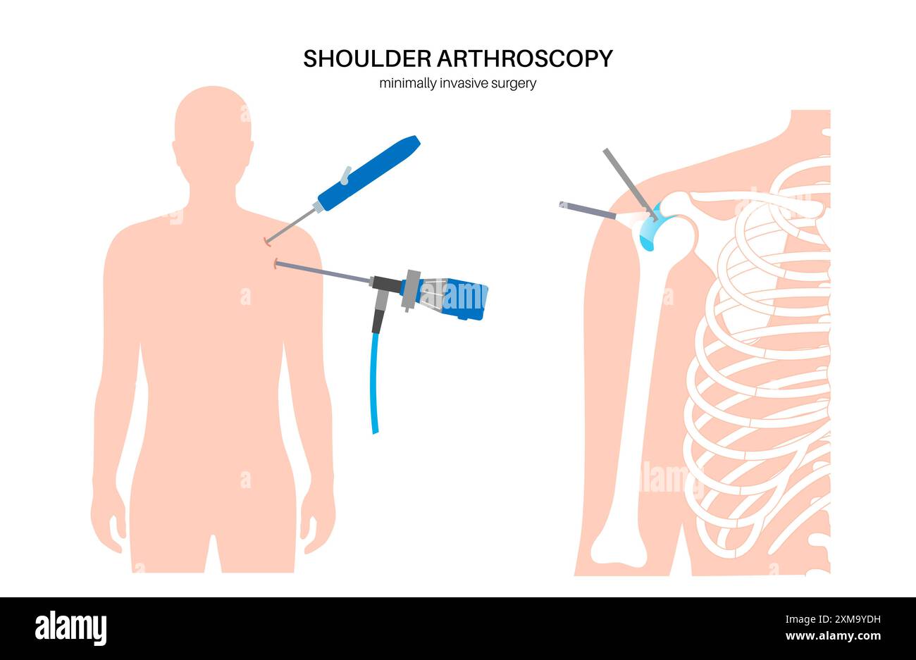 Shoulder Incision Names Illustration of a shoulder arthroscopy procedure. This is a procedure ...