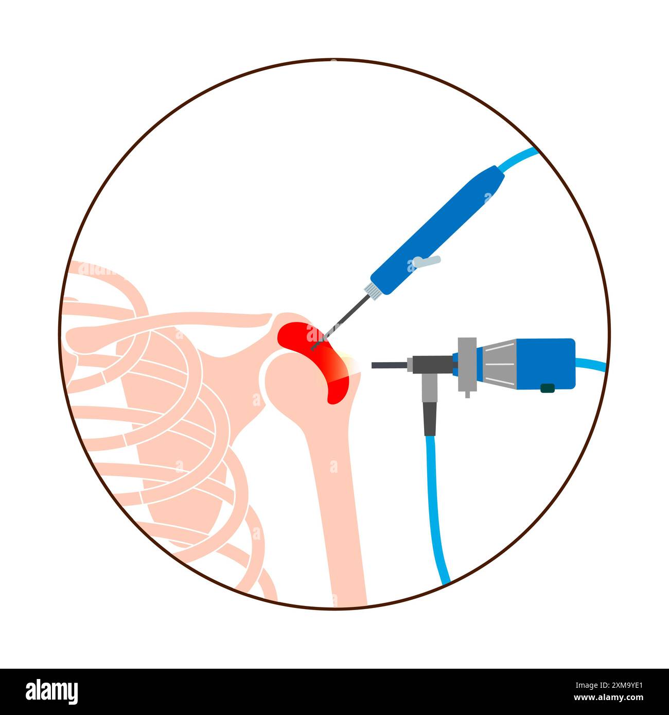 Illustration of a shoulder arthroscopy procedure. This is a procedure