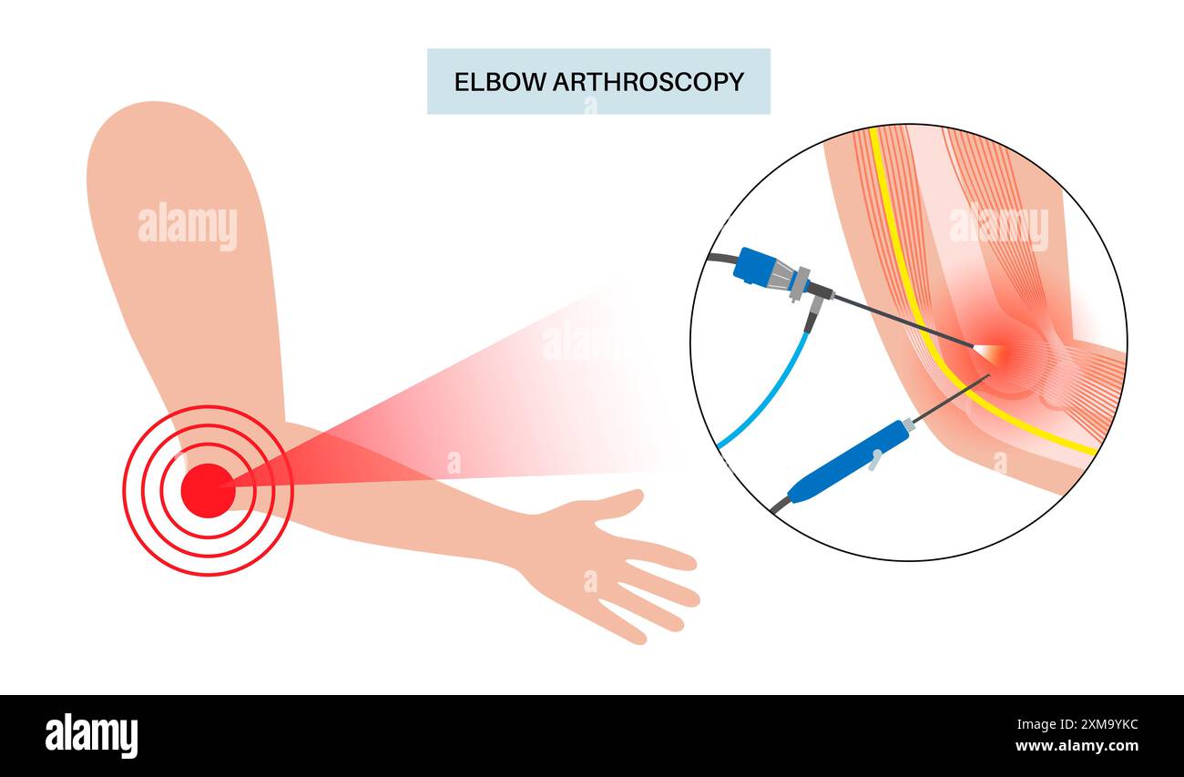 Small Incsion Illustration of elbow arthroscopy surgery. This is a procedure for ...