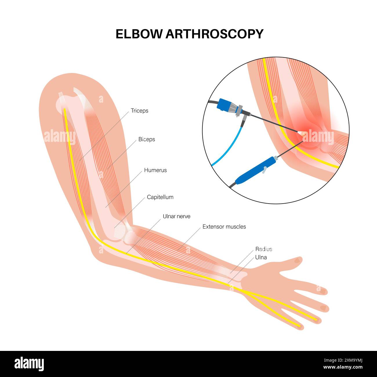Illustration of elbow arthroscopy surgery. This is a procedure for ...