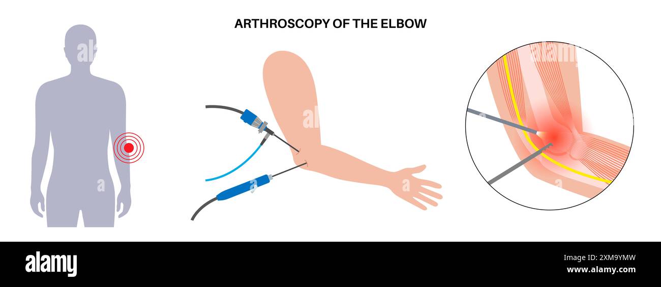 Illustration of elbow arthroscopy surgery. This is a procedure for ...