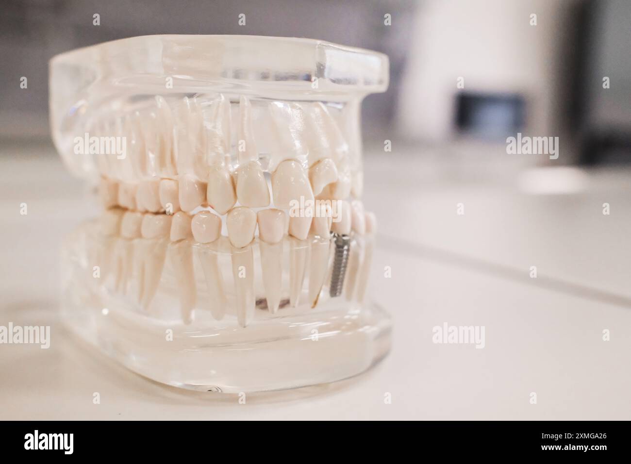 educational model of human jaw with teeth and implants Stock Photo - Alamy