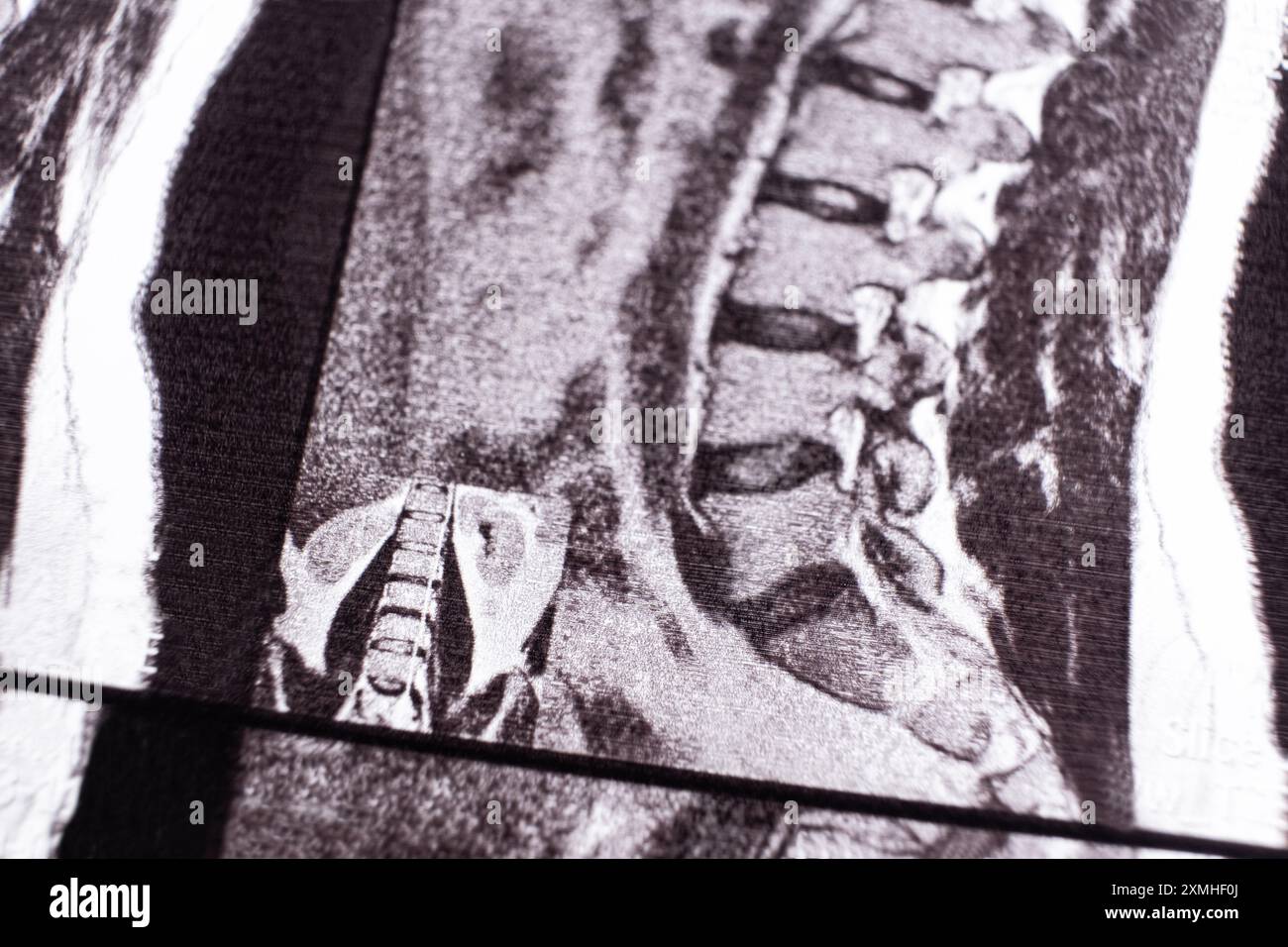Xray of spine curvature hi-res stock photography and images - Alamy