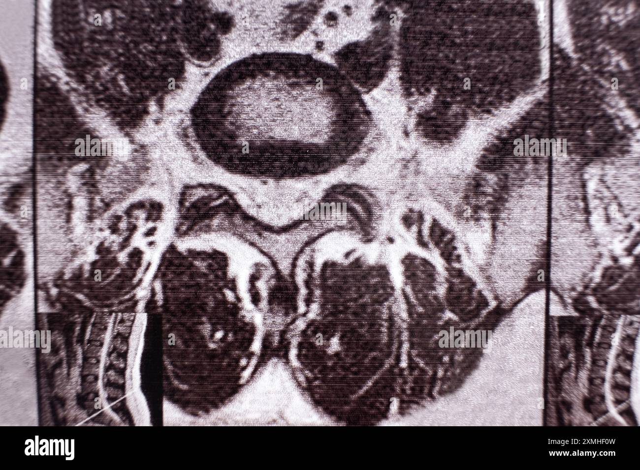 Mri of thoracic spine hi-res stock photography and images - Alamy
