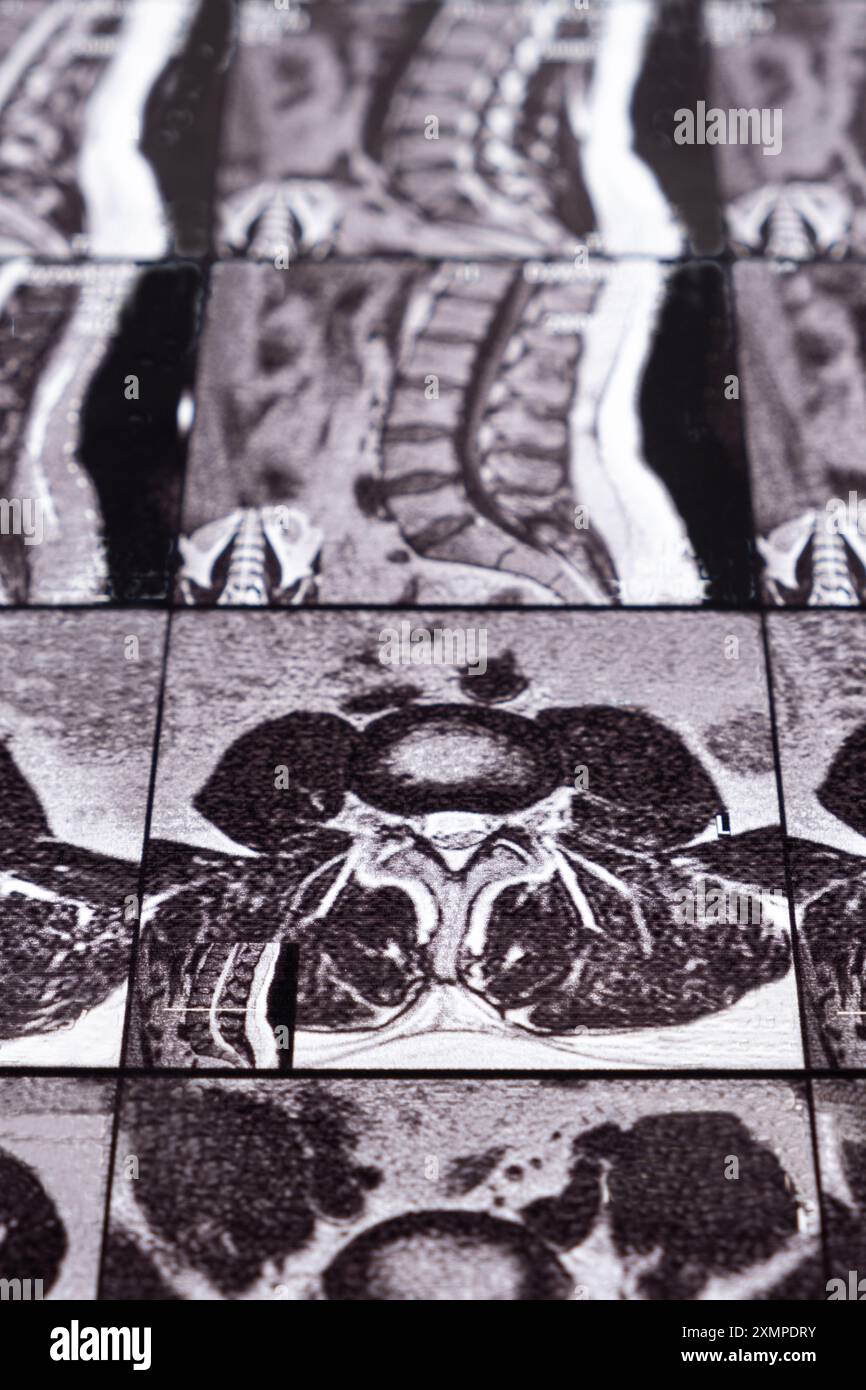 Mri of thoracic spine hi-res stock photography and images - Alamy