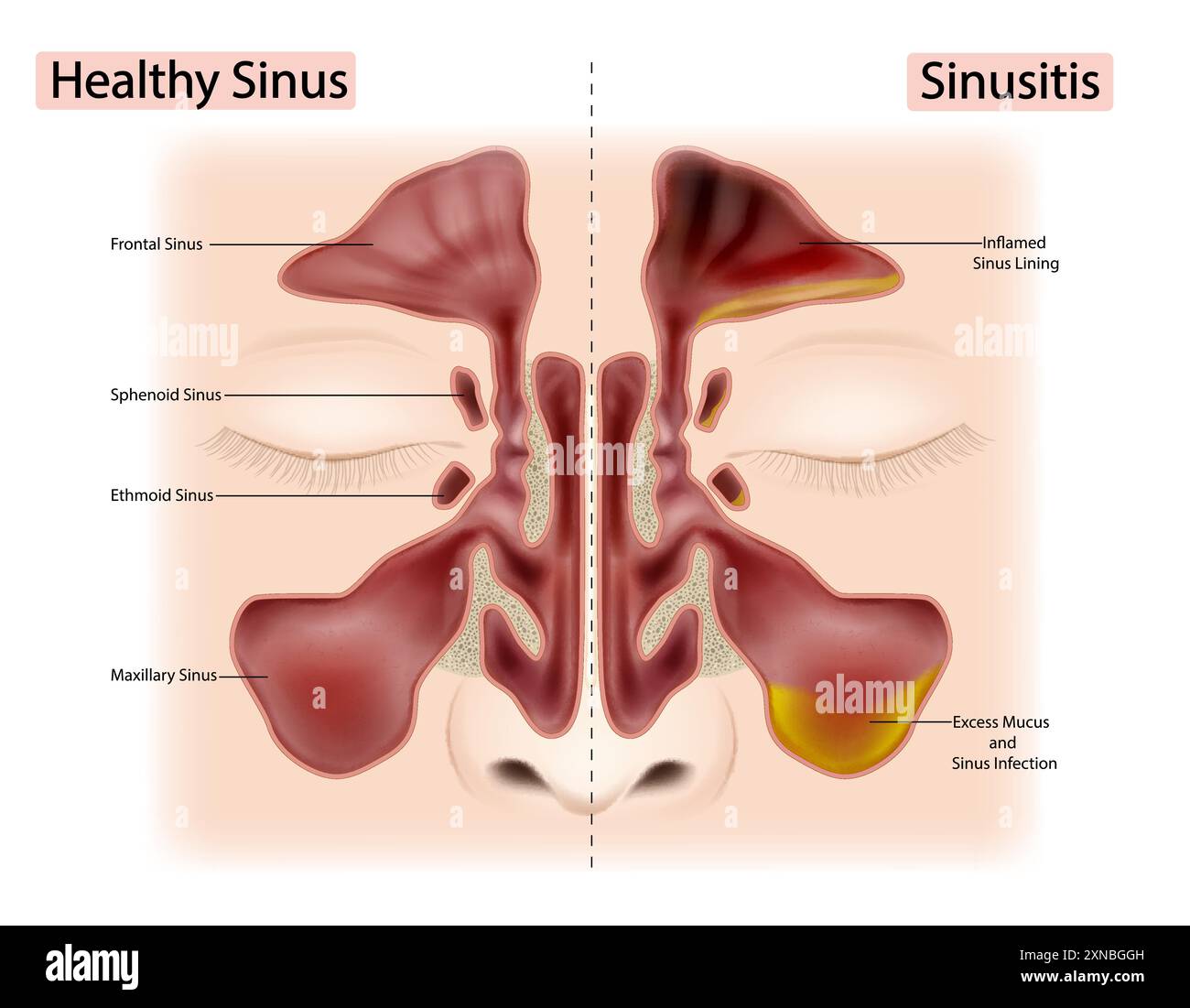 Sinus Image Bony Maxillary Sinus Anatomy Cerebral Complexity Preceded Enlarged