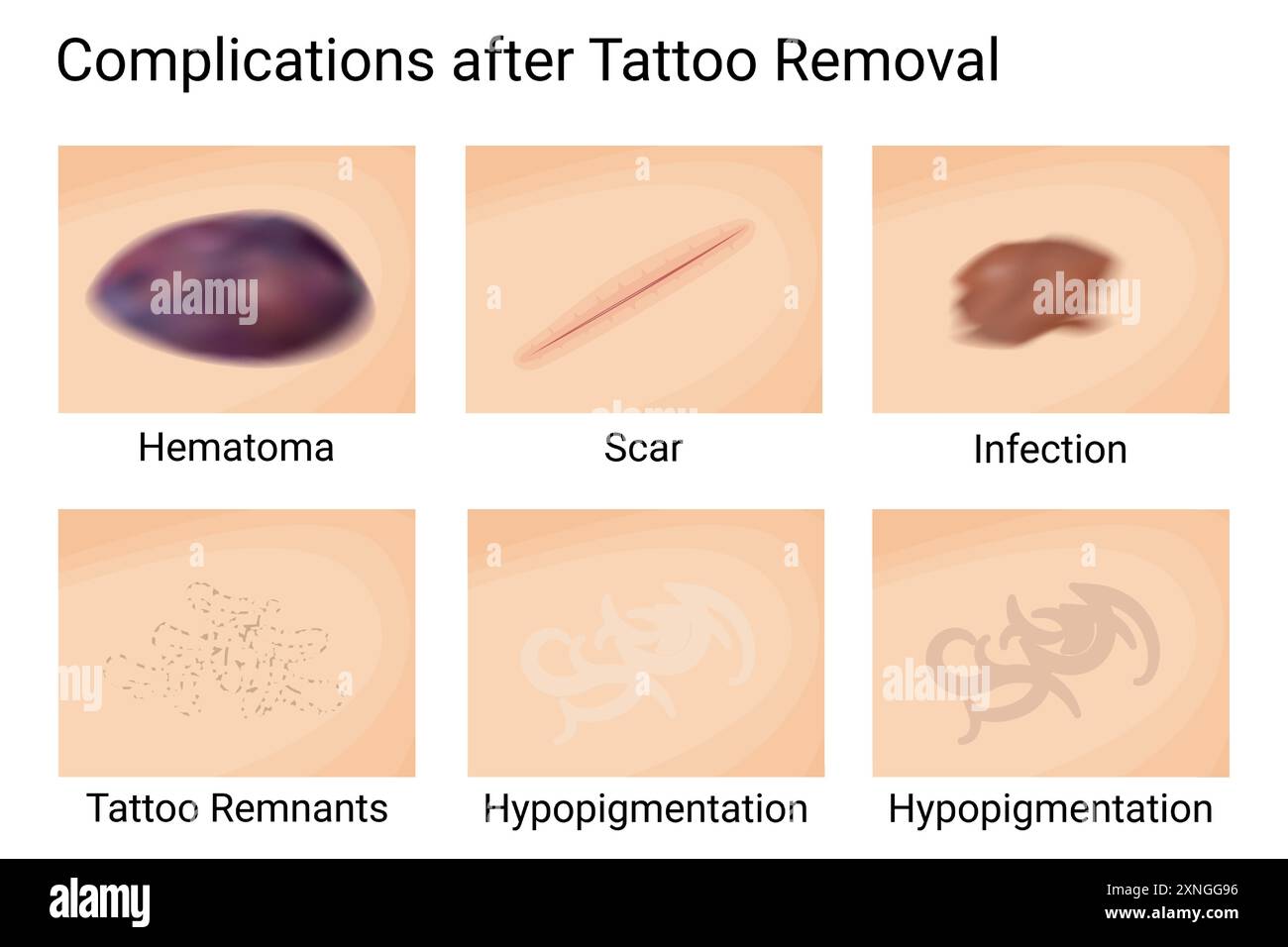 Complication Skin Problem Skin Complications Post Tattoo Removal. Vector illustration design ...