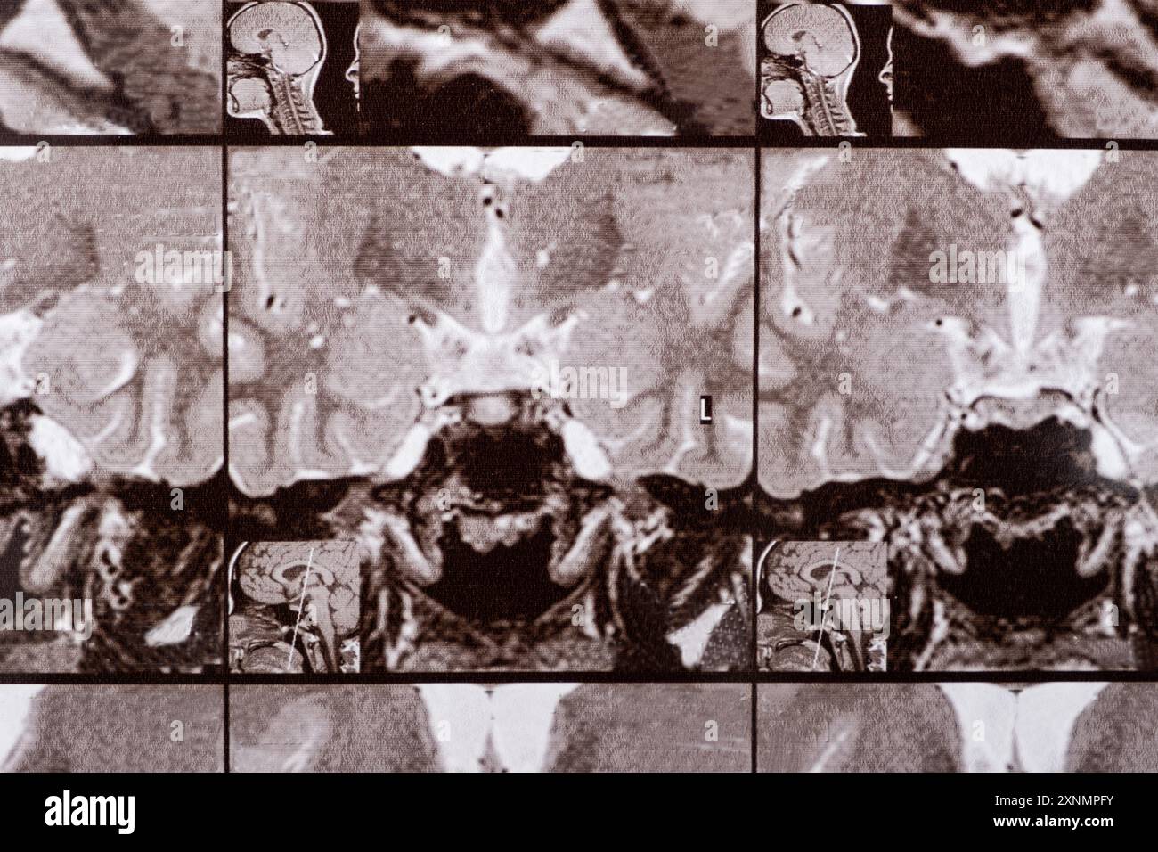 Magnetic Resonance Imaging Changes In The Pituitary Gland – EOHPE
