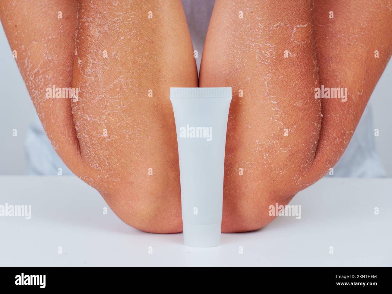 Close-up of person's elbows with dry, flaky skin alongside a white, blank moisturizer tube on a table. Ideal for illustrating skin care solutions. Stock Photo