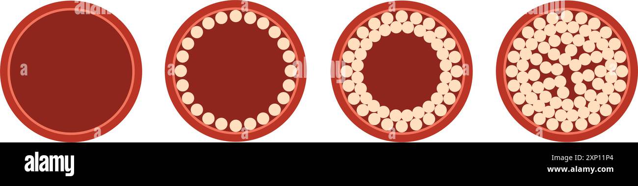 Artery Anatomical Model Anatomical Vessel Atherosclerosis Thrombus Vascular Model Human Artery Anatomy Model