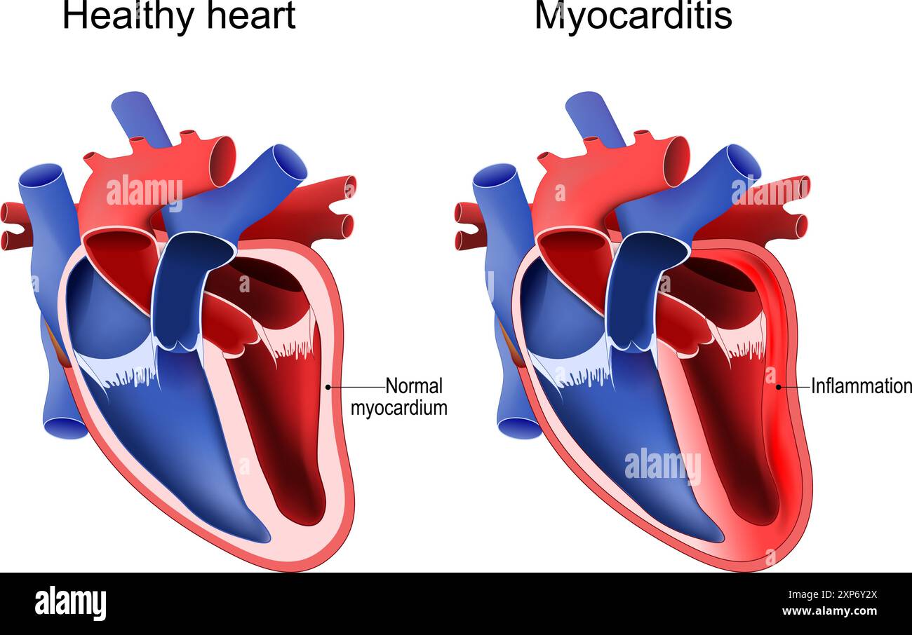 Myocarditis. Healthy heart with Normal myocardium and Cardiac inflammation. Heart anatomy. Vector illustration Stock Vector