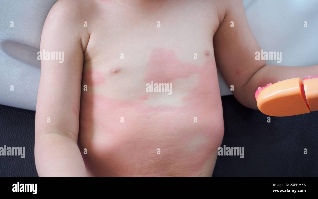 Severe eczema skin rash and allergic reaction symtom at little asian ...