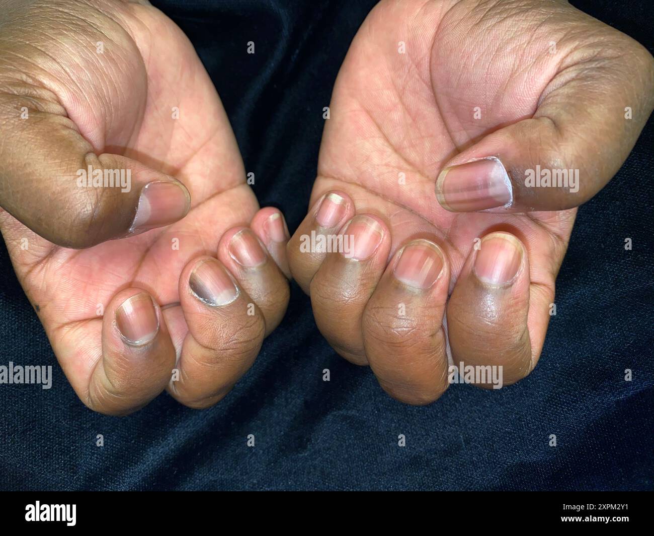 Nails of a 34 year old African American female patient with longitudinal  (lengthwise) melanonychia. Melanonychia is a nail discolouration caused by  the pigment melanin. It may be the equivalent of a mole, image size:1300x1064