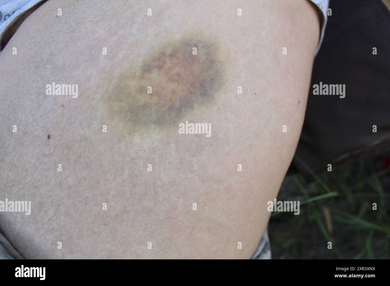 Bruise on the leg. A large round bruise of dark blue color on the leg